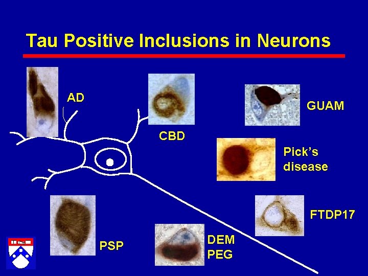 Tau Positive Inclusions in Neurons AD GUAM CBD Pick’s disease FTDP 17 PSP DEM
