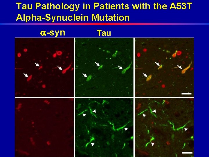 Tau Pathology in Patients with the A 53 T Alpha-Synuclein Mutation -syn Tau 