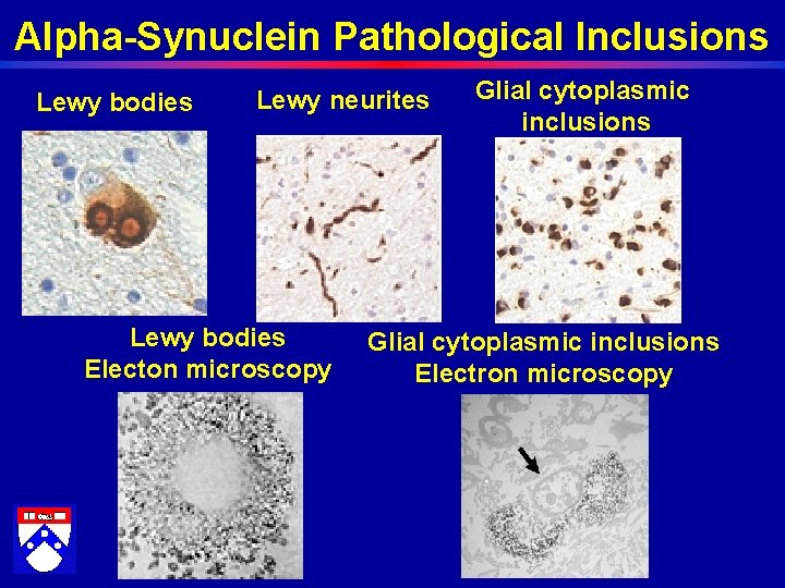 Alpha-Synuclein Pathological Inclusions Lewy bodies Lewy neurites Lewy bodies Electon microscopy Glial cytoplasmic inclusions