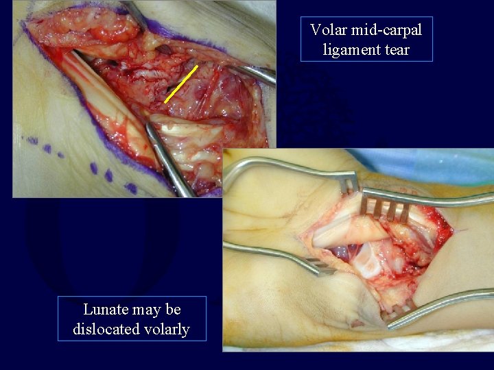 Volar mid-carpal ligament tear Lunate may be dislocated volarly 