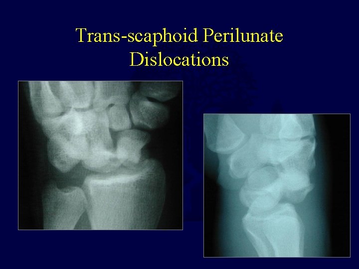 Trans-scaphoid Perilunate Dislocations 