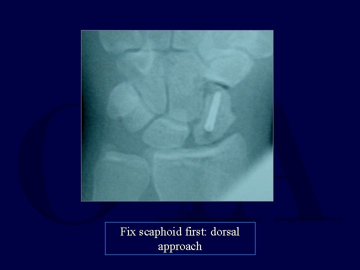 Fix scaphoid first: dorsal approach 