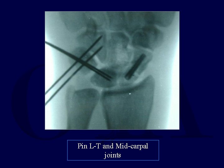 Pin L-T and Mid-carpal joints 