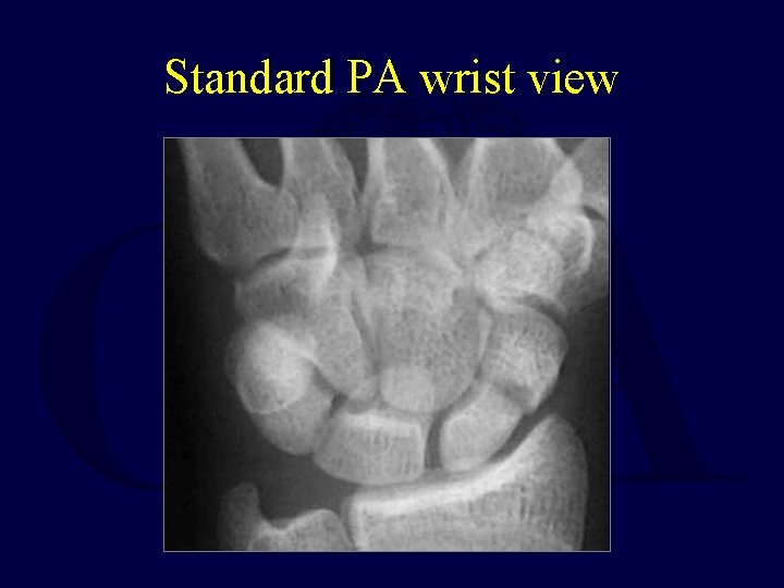 Standard PA wrist view 