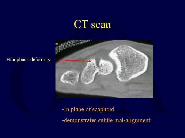 CT scan Humpback deformity -In plane of scaphoid -demonstrates subtle mal-alignment 