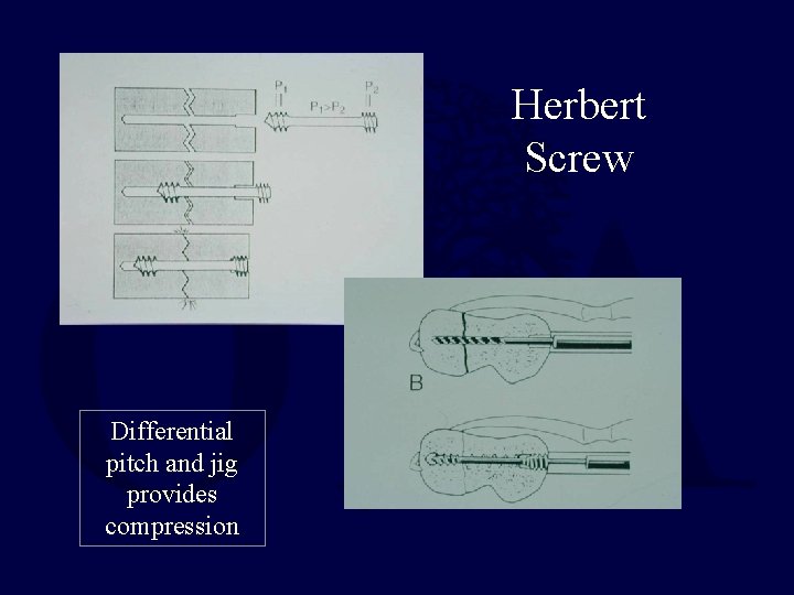 Herbert Screw Differential pitch and jig provides compression 