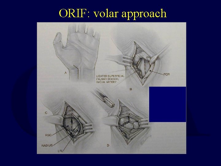ORIF: volar approach 