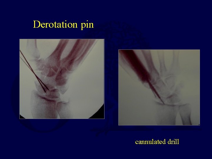 Derotation pin cannulated drill 