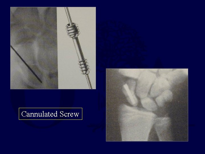 Cannulated Screw 