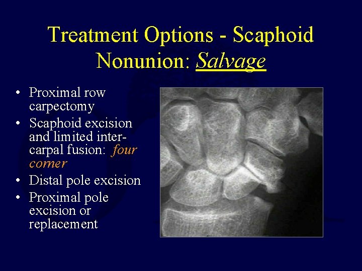 Treatment Options - Scaphoid Nonunion: Salvage • Proximal row carpectomy • Scaphoid excision and