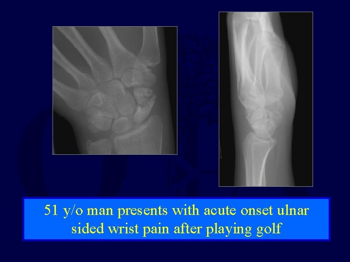 51 y/o man presents with acute onset ulnar sided wrist pain after playing golf