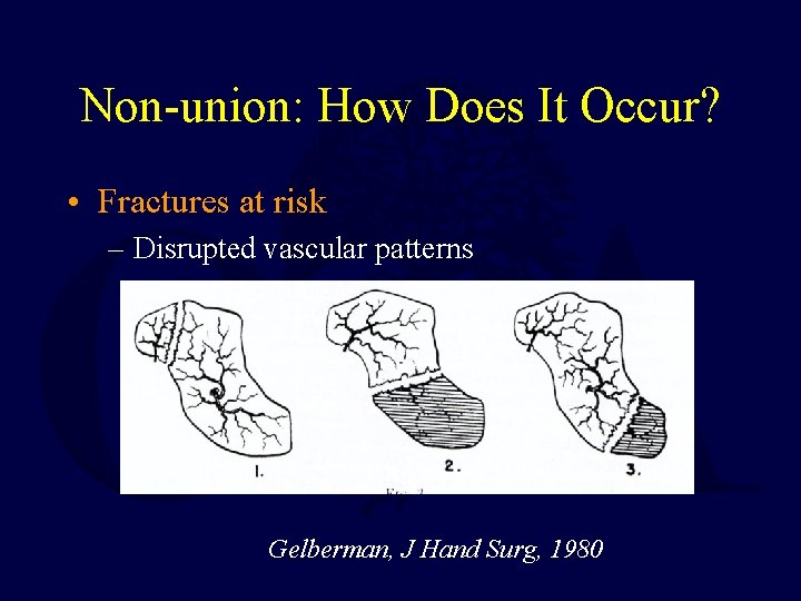 Non-union: How Does It Occur? • Fractures at risk – Disrupted vascular patterns Gelberman,