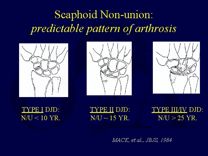 Scaphoid Non-union: predictable pattern of arthrosis TYPE I DJD: N/U < 10 YR. TYPE