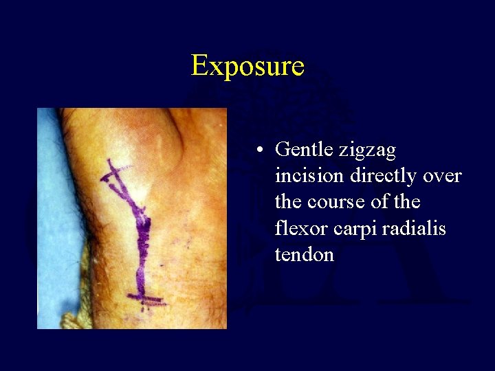 Exposure • Gentle zigzag incision directly over the course of the flexor carpi radialis