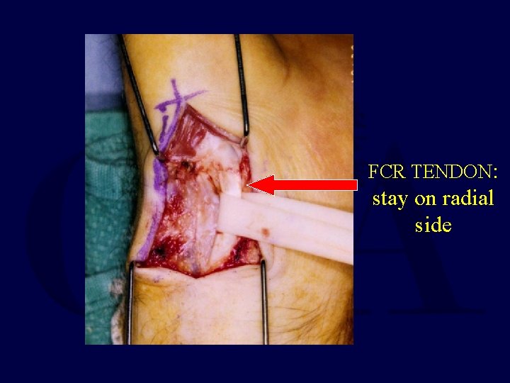 FCR TENDON: stay on radial side 