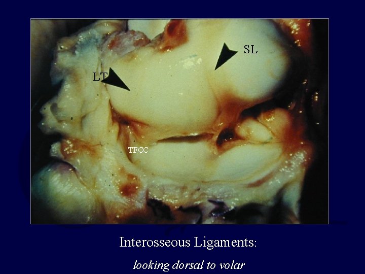 SL LT TFCC Interosseous Ligaments: looking dorsal to volar 