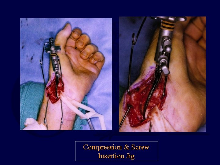 Compression & Screw Insertion Jig 