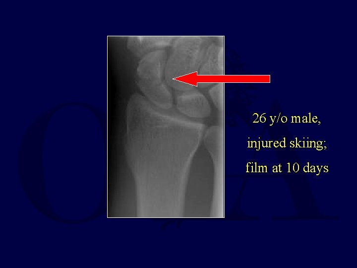 26 y/o male, injured skiing; film at 10 days 