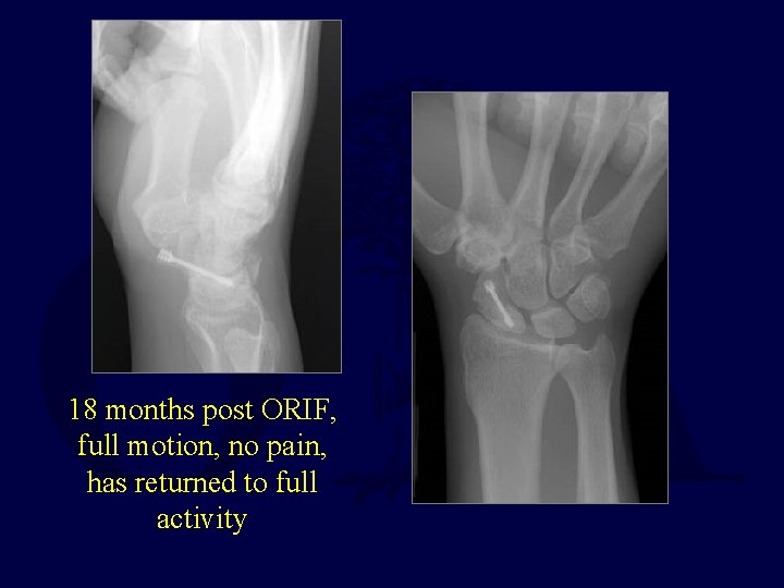 18 months post ORIF, full motion, no pain, has returned to full activity 
