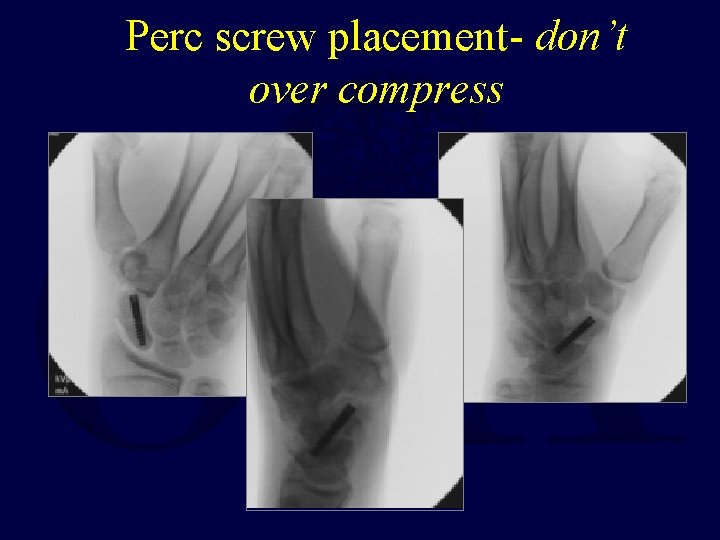 Perc screw placement- don’t over compress 