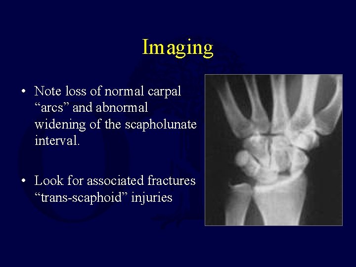 Imaging • Note loss of normal carpal “arcs” and abnormal widening of the scapholunate