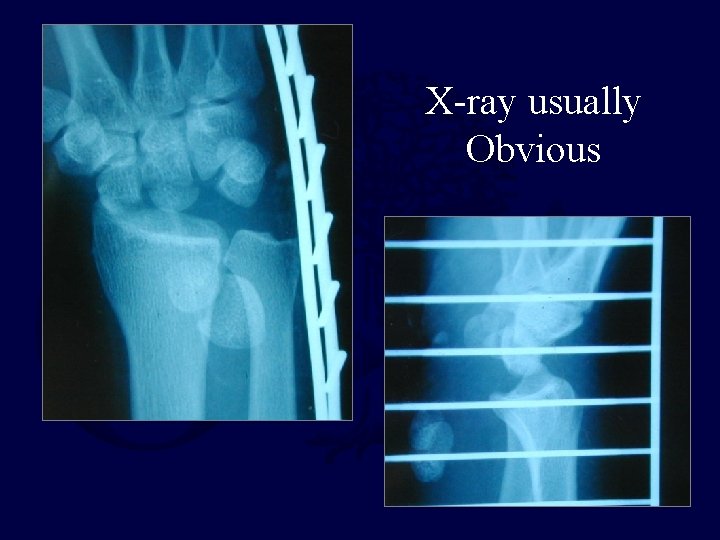 X-ray usually Obvious 