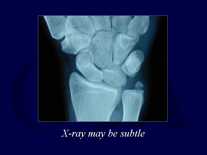 X-ray may be subtle 