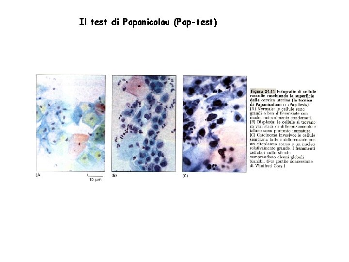 Il test di Papanicolau (Pap-test) 