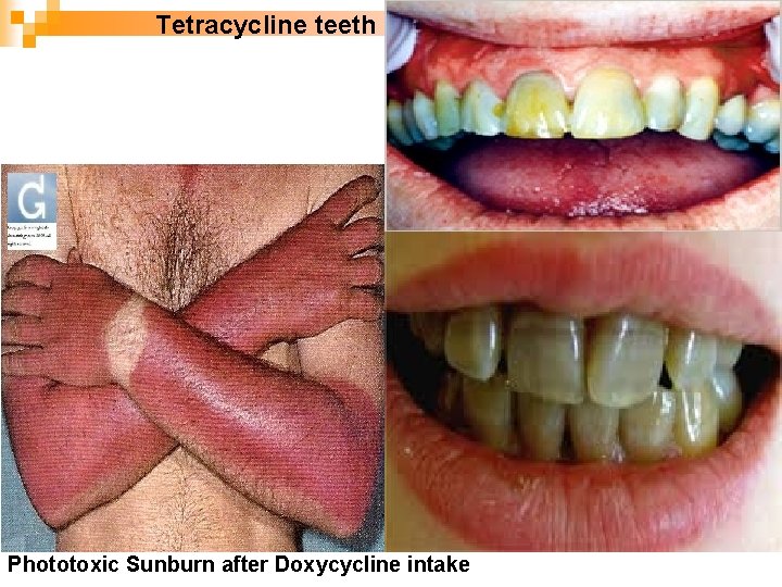 Tetracycline teeth Phototoxic Sunburn after Doxycycline intake 