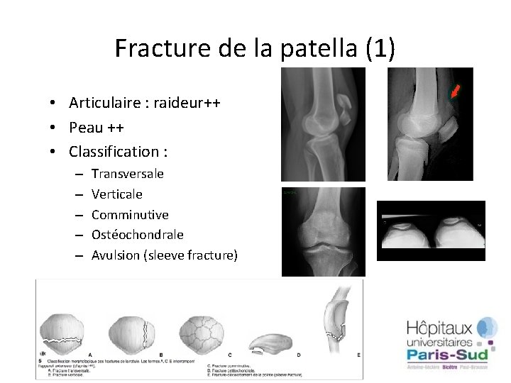 Fracture de la patella (1) • Articulaire : raideur++ • Peau ++ • Classification