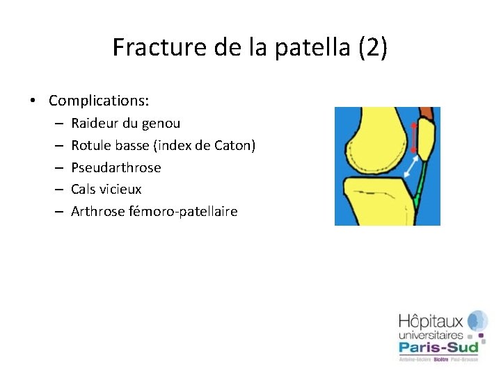 Fracture de la patella (2) • Complications: – – – Raideur du genou Rotule
