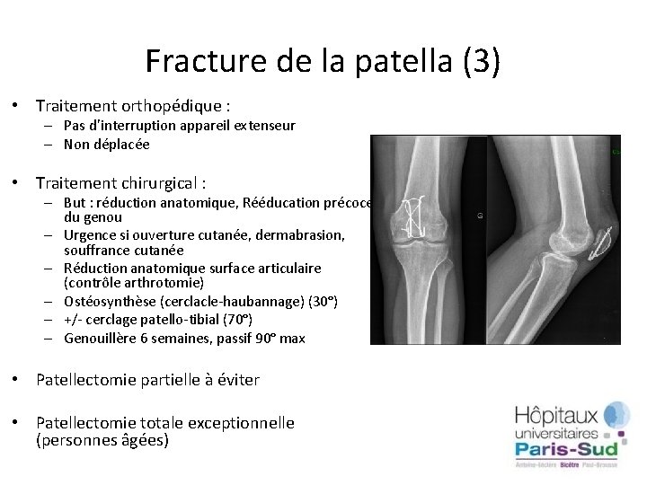 Fracture de la patella (3) • Traitement orthopédique : – Pas d’interruption appareil extenseur