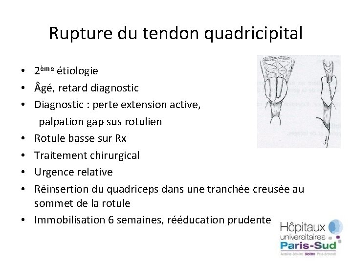 Rupture du tendon quadricipital • 2ème étiologie • gé, retard diagnostic • Diagnostic :