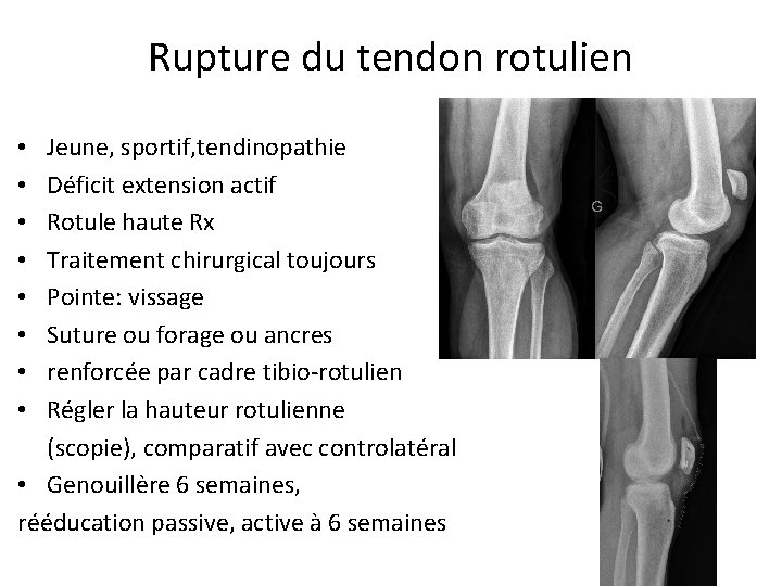 Rupture du tendon rotulien Jeune, sportif, tendinopathie Déficit extension actif Rotule haute Rx Traitement