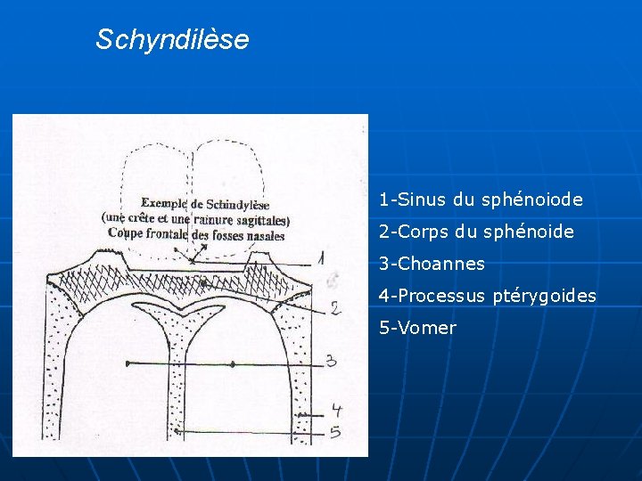 Schyndilèse 1 -Sinus du sphénoiode 2 -Corps du sphénoide 3 -Choannes 4 -Processus ptérygoides