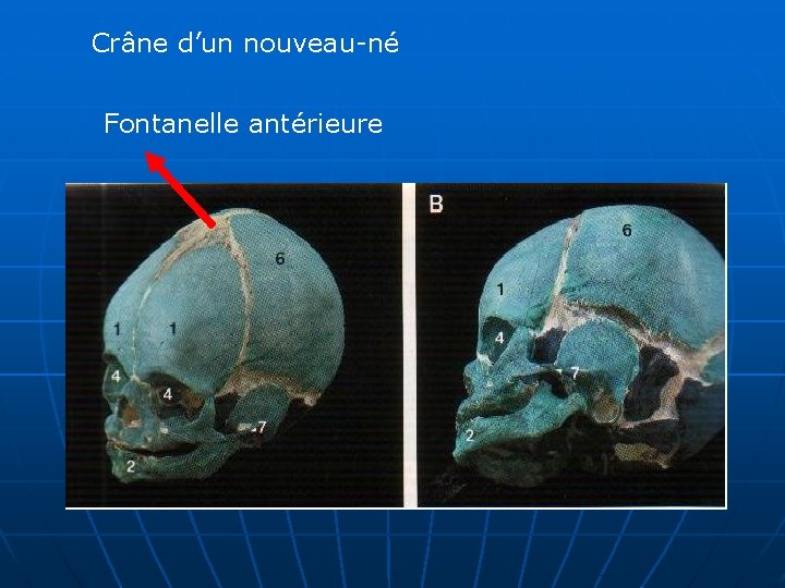 Crâne d’un nouveau-né Fontanelle antérieure 