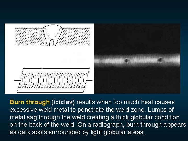  Burn through (icicles) results when too much heat causes excessive weld metal to