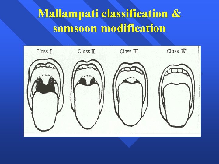 Mallampati classification & samsoon modification 