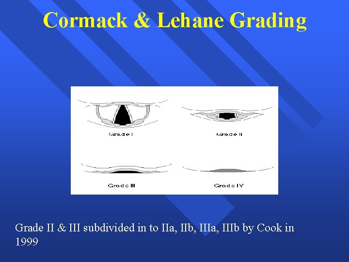 Cormack & Lehane Grading Grade II & III subdivided in to IIa, IIb, IIIa,