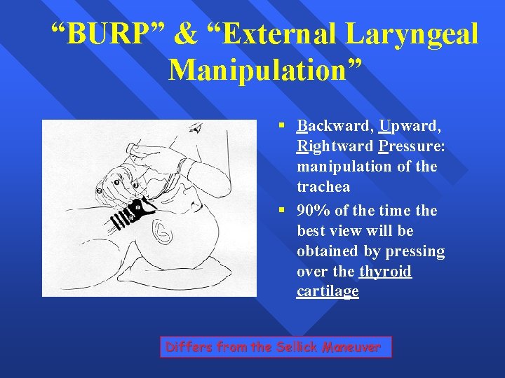 “BURP” & “External Laryngeal Manipulation” § Backward, Upward, Rightward Pressure: manipulation of the trachea