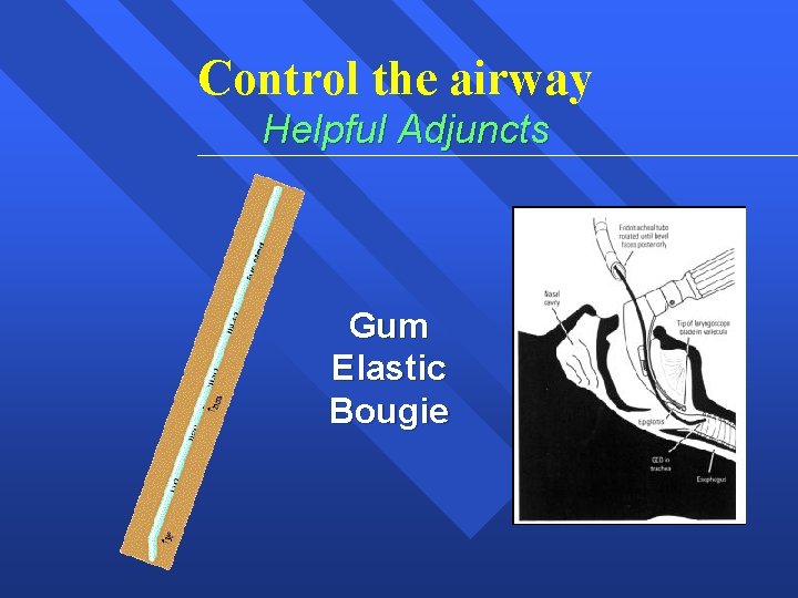 Control the airway Helpful Adjuncts Gum Elastic Bougie 