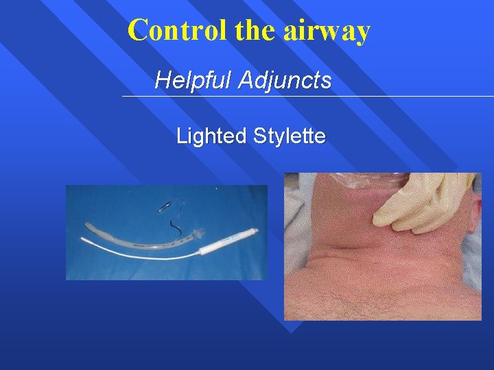 Control the airway Helpful Adjuncts Lighted Stylette 