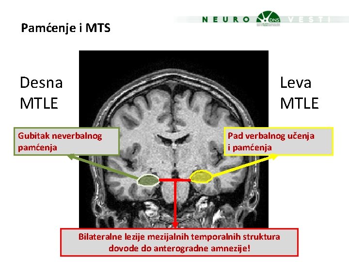 Pamćenje i MTS Desna MTLE Leva MTLE Gubitak neverbalnog pamćenja Pad verbalnog učenja i
