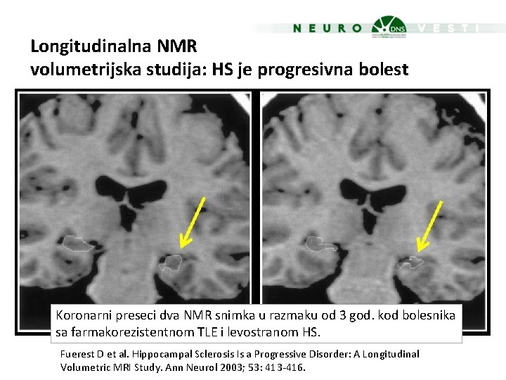 Longitudinalna NMR volumetrijska studija: HS je progresivna bolest Koronarni preseci dva NMR snimka u