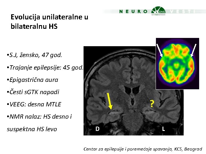 Evolucija unilateralne u bilateralnu HS • S. J, žensko, 47 god. • Trajanje epilepsije:
