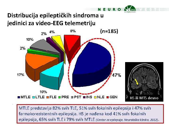 Distribucija epileptičkih sindroma u jedinici za video-EEG telemetriju (n=185) HS ili MTS desno MTLE