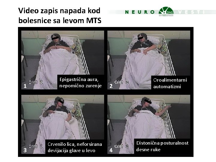 Video zapis napada kod bolesnice sa levom MTS Epigastrična aura, nepomično zurenje Oroalimentarni automatizmi