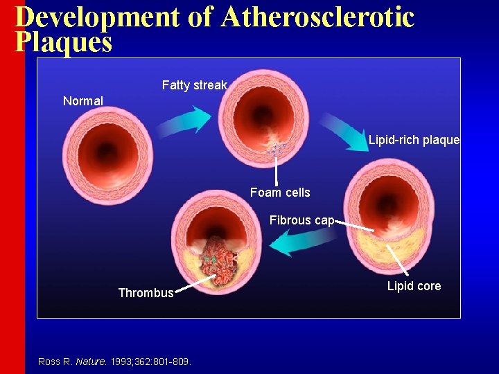 Development of Atherosclerotic Plaques Fatty streak Normal Lipid-rich plaque Foam cells Fibrous cap Thrombus