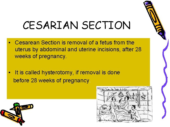 CESARIAN SECTION • Cesarean Section is removal of a fetus from the uterus by