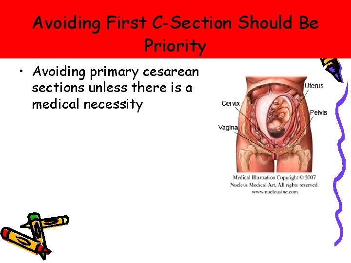Avoiding First C-Section Should Be Priority • Avoiding primary cesarean sections unless there is